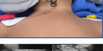 AIIMS doctors remove 2-inch-long metal spring from 14-month-old’s food pipe