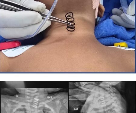 AIIMS doctors remove 2-inch-long metal spring from 14-month-old’s food pipe
