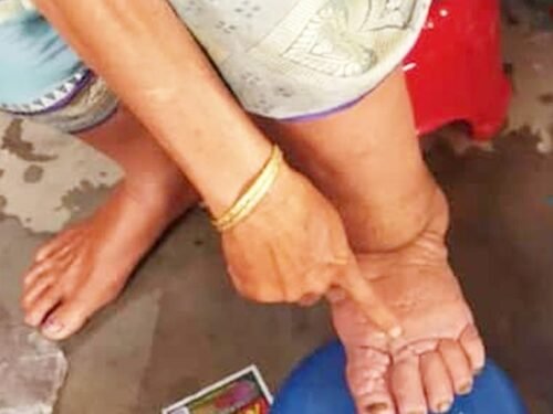 Mass drug programme against filariasis to begin in Gujarat from Feb 10, covering 5.48 lakh