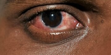 Conjunctivitis cases rise in Chennai; doctors stress hygiene, early treatment