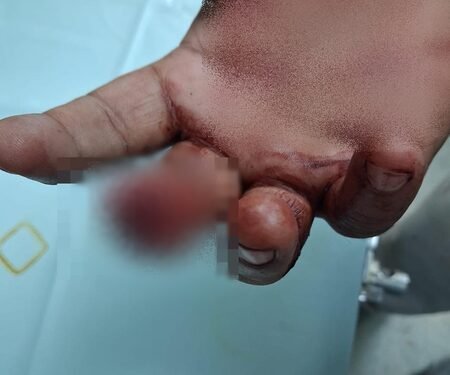 Bloody brawl at samosa-cutlet shop in Mumbai: Customer bites off shopkeeper’s finger, accused arrested