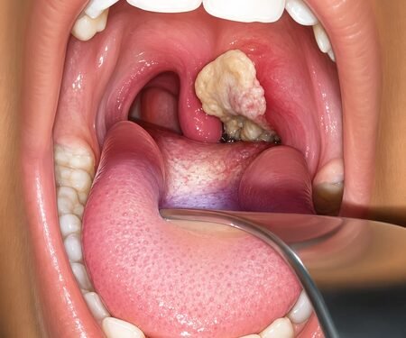 Australia’s diphtheria outbreak spreads beyond Northern Territory