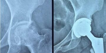 Gujarat: Ahmedabad Civil Hospital performs high-risk hip replacement on woman with serious blood disorder