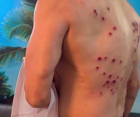 Gaurav Khanna shows painful laser burn marks on his back from ‘Khatron Ke Khiladi’ task